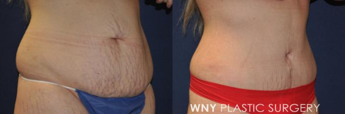 Before & After Mommy Makeover Case 236 Right Oblique View in Buffalo, NY