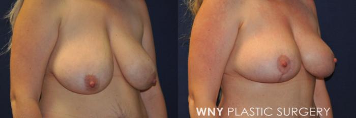 Before & After Breast Lift Case 236 Right Oblique Upper View in Buffalo, NY