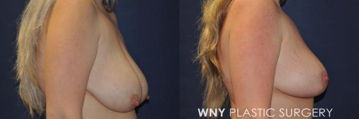 Before & After Breast Lift Case 236 Right Side Upper View in Buffalo, NY