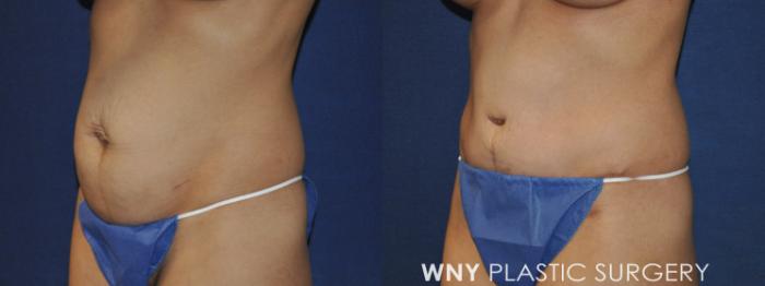 Before & After Mommy Makeover Case 237 Left Oblique View in Buffalo, NY