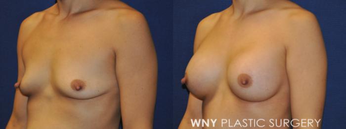 Before & After Mommy Makeover Case 237 Left Oblique Upper View in Buffalo, NY