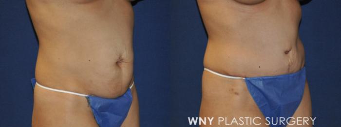 Before & After Mommy Makeover Case 237 Right Oblique View in Buffalo, NY