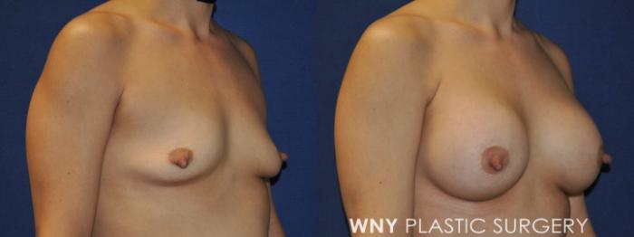 Before & After Mommy Makeover Case 237 Right Oblique Upper View in Buffalo, NY