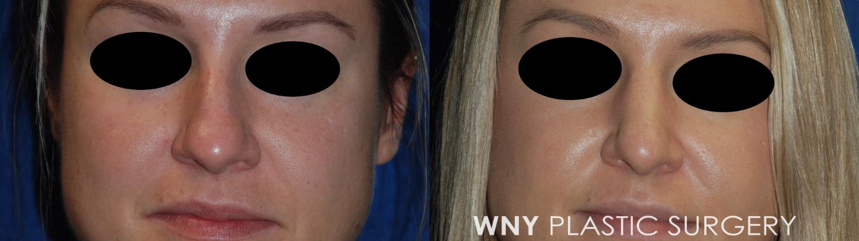 Before & After Rhinoplasty Case 111 Front View in Williamsville, NY