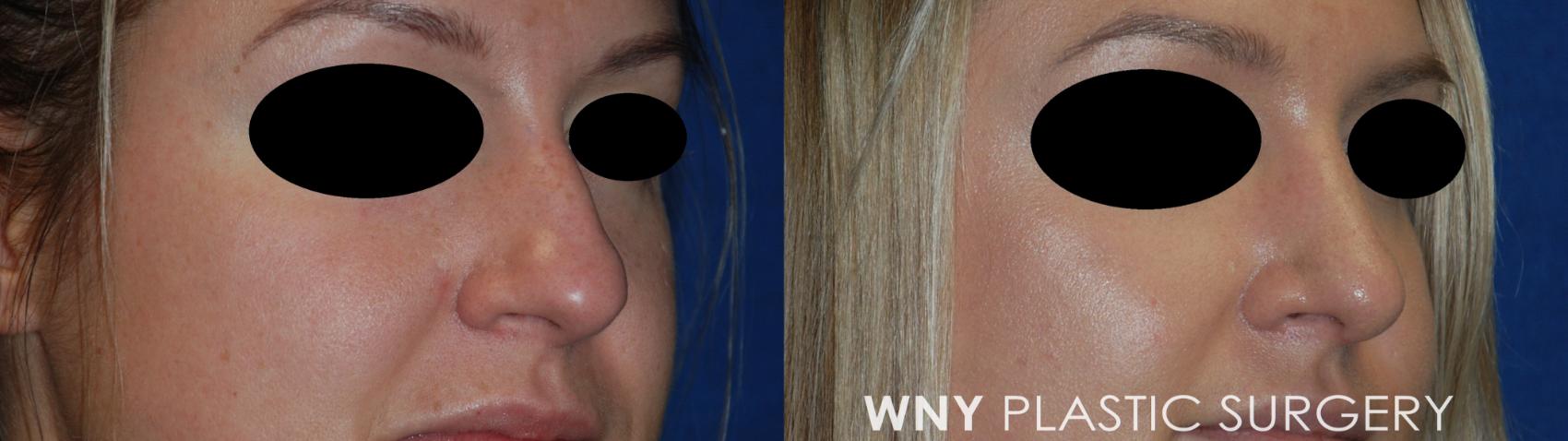 Before & After Rhinoplasty Case 111 Right Oblique View in Williamsville, NY