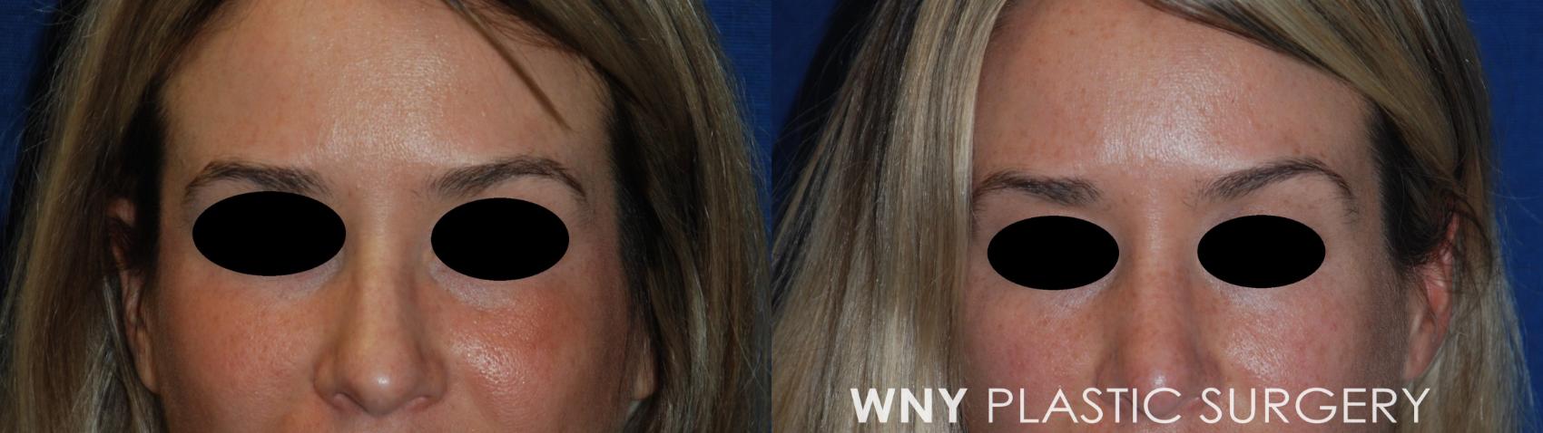 Before & After Rhinoplasty Case 164 Front View in Williamsville, NY