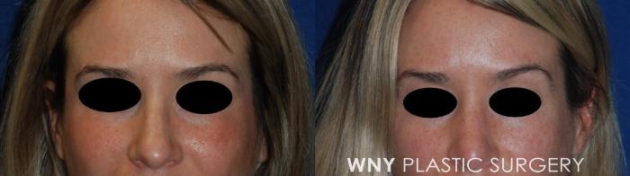 Before & After Rhinoplasty Case 164 Front View in Buffalo, NY