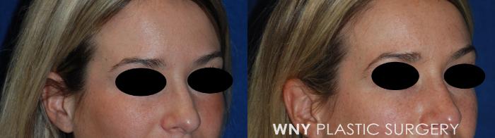 Before & After Rhinoplasty Case 164 Right Oblique View in Buffalo, NY