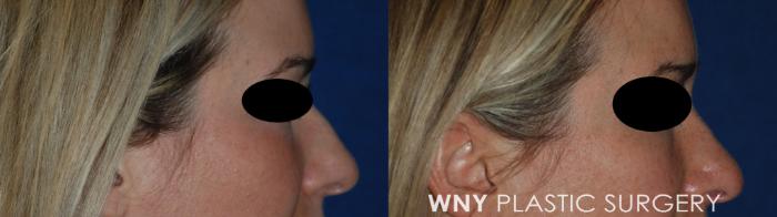 Before & After Rhinoplasty Case 164 Right Side View in Williamsville, NY