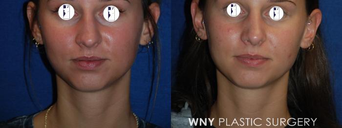 Before & After Rhinoplasty Case 173 Front View in Williamsville, NY