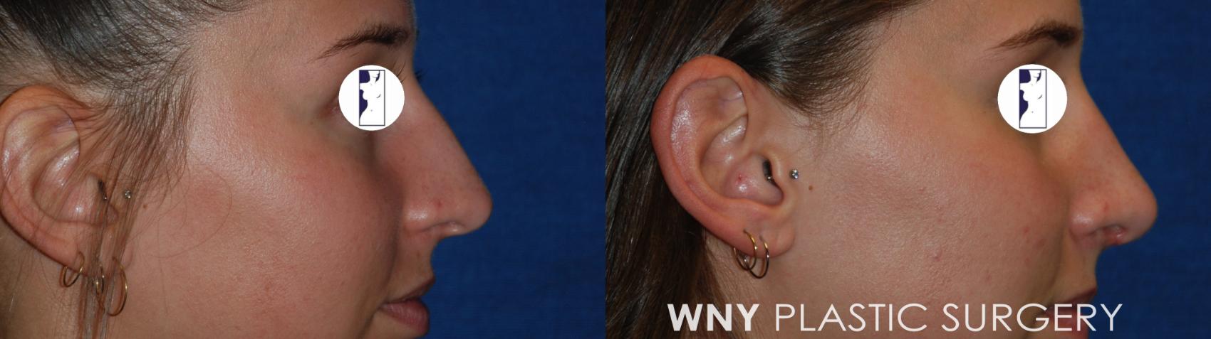 Before & After Rhinoplasty Case 173 Right Side View in Buffalo, NY