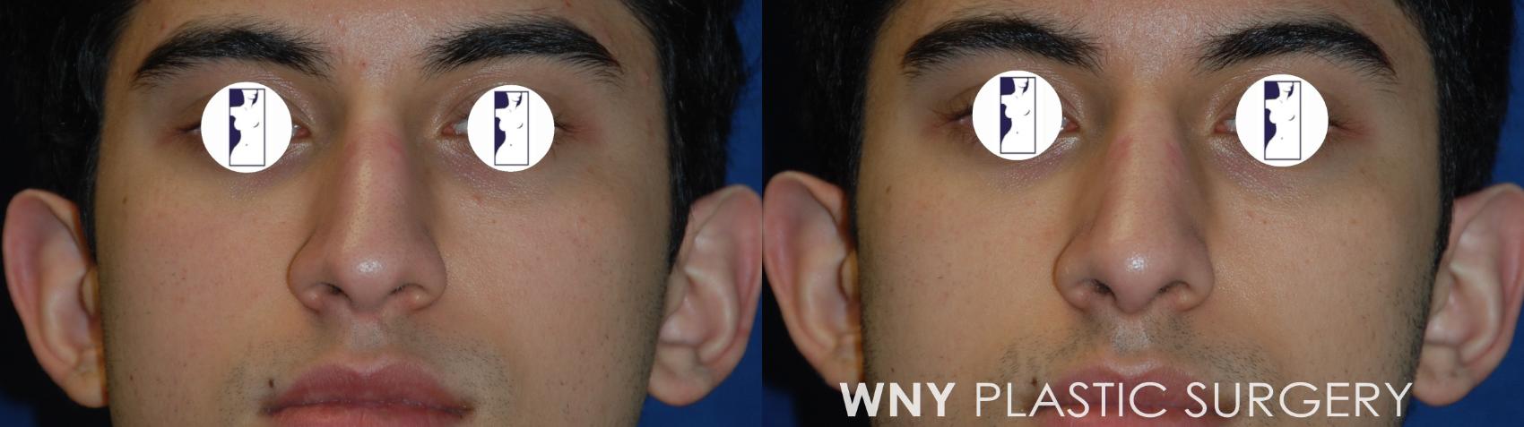 Before & After Rhinoplasty Case 178 Front View in Williamsville, NY