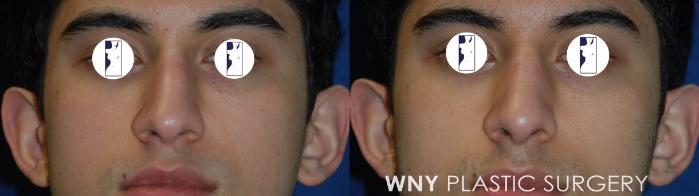 Before & After Rhinoplasty Case 178 Front View in Buffalo, NY