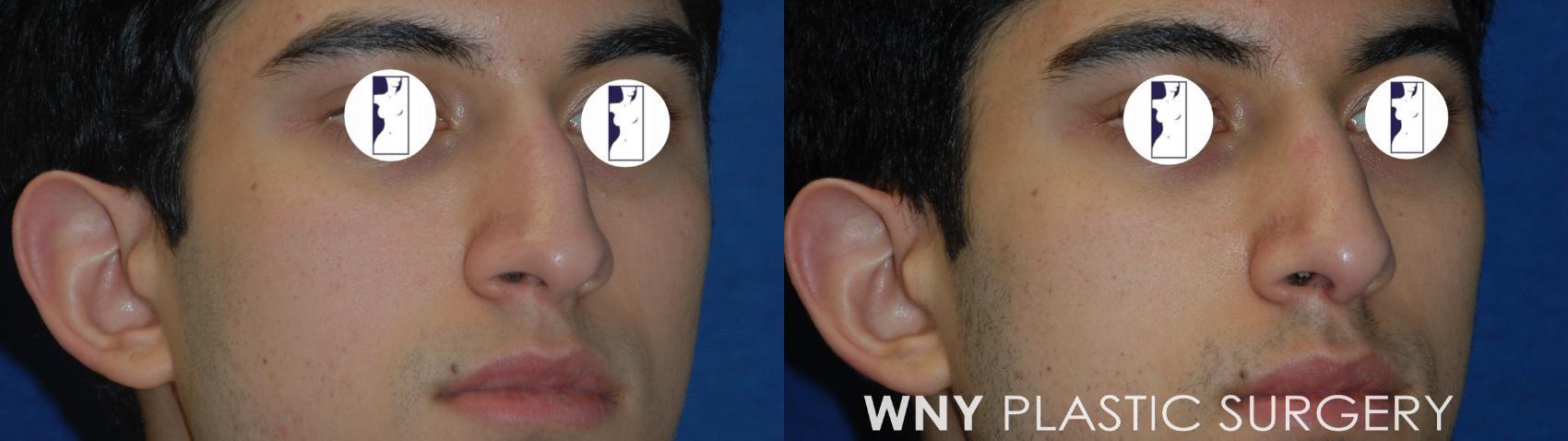 Before & After Rhinoplasty Case 178 Right Oblique View in Williamsville, NY