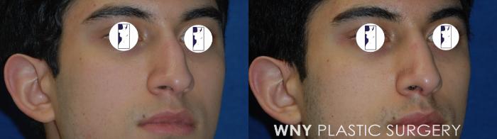 Before & After Rhinoplasty Case 178 Right Oblique View in Buffalo, NY