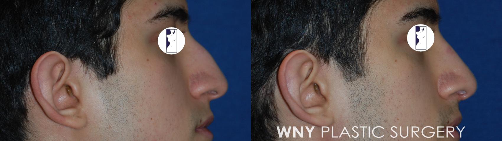 Before & After Rhinoplasty Case 178 Right Side View in Buffalo, NY