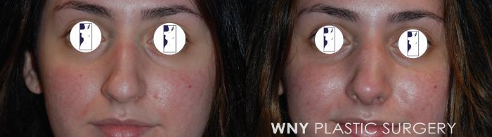 Before & After Rhinoplasty Case 180 Front View in Williamsville, NY