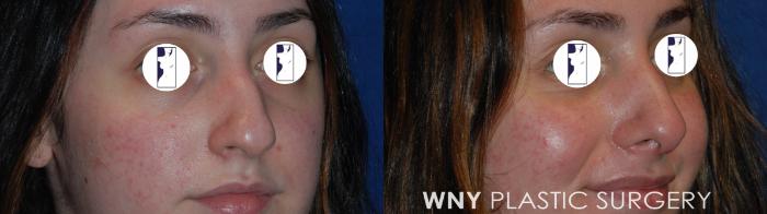 Before & After Rhinoplasty Case 180 Right Oblique View in Williamsville, NY