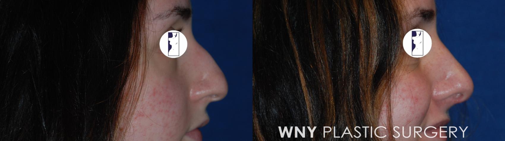 Before & After Rhinoplasty Case 180 Right Side View in Williamsville, NY