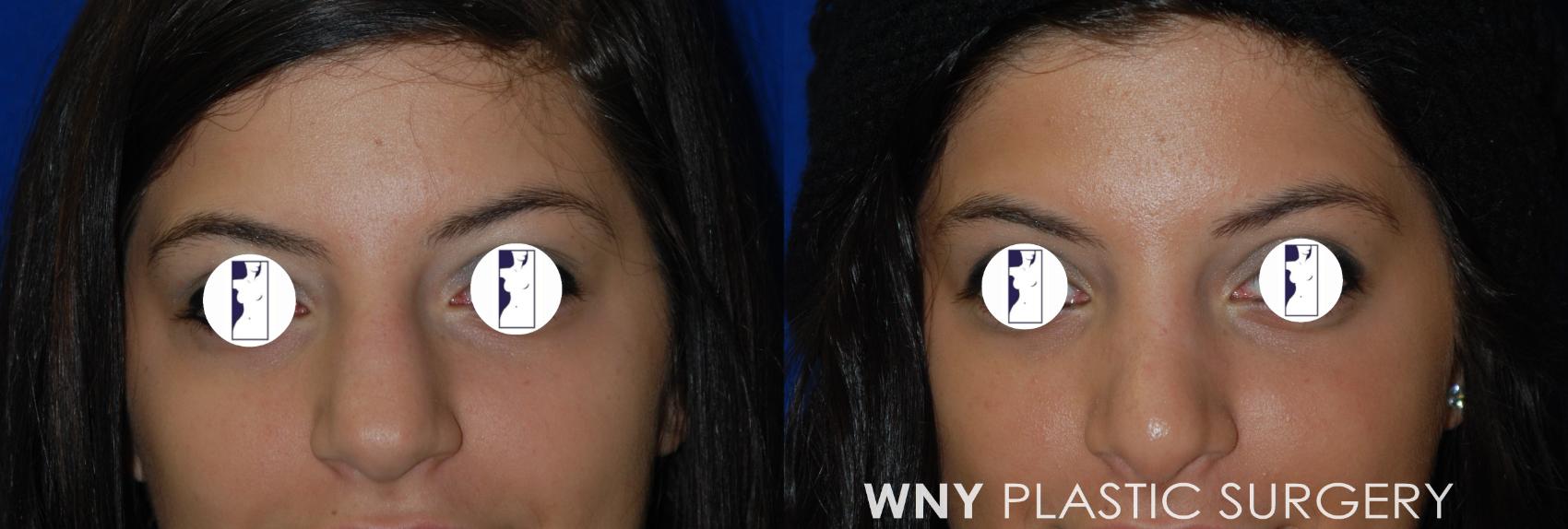 Before & After Rhinoplasty Case 42 Front View in Williamsville, NY