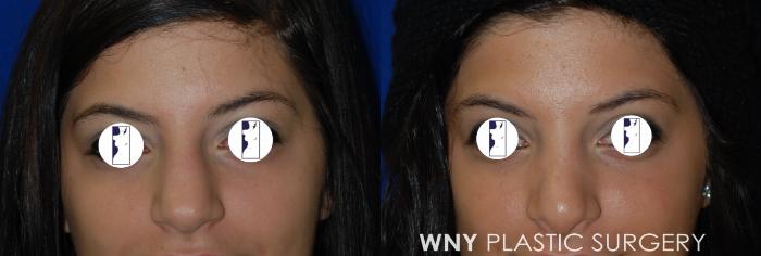 Before & After Rhinoplasty Case 42 Front View in Buffalo, NY