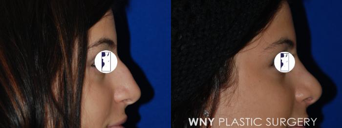 Before & After Rhinoplasty Case 42 Right Side View in Williamsville, NY