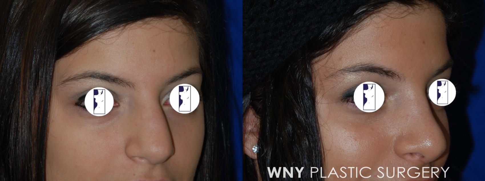 Before & After Rhinoplasty Case 42 View #2 View in Williamsville, NY