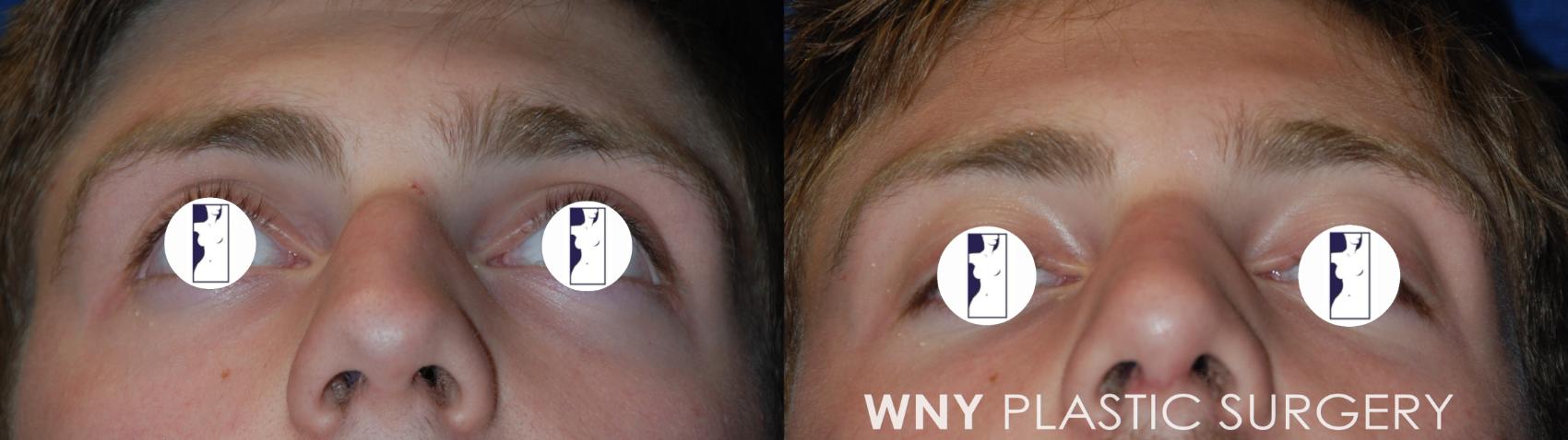 Before & After Rhinoplasty Case 66 Bottom View in Williamsville, NY