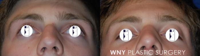 Before & After Rhinoplasty Case 66 Bottom View in Buffalo, NY