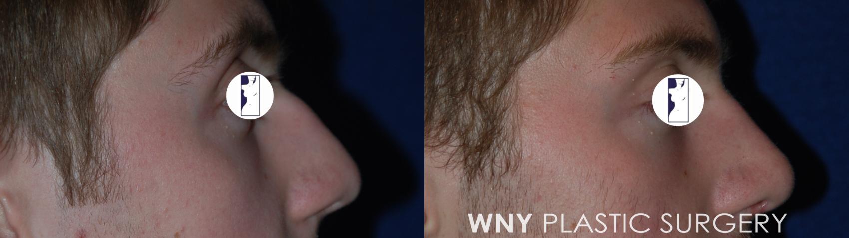 Before & After Rhinoplasty Case 66 View #3 View in Williamsville, NY