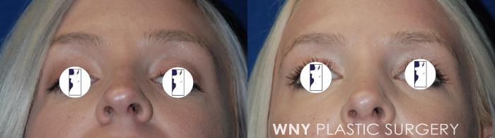 Before & After Rhinoplasty Case 67 Bottom View in Williamsville, NY