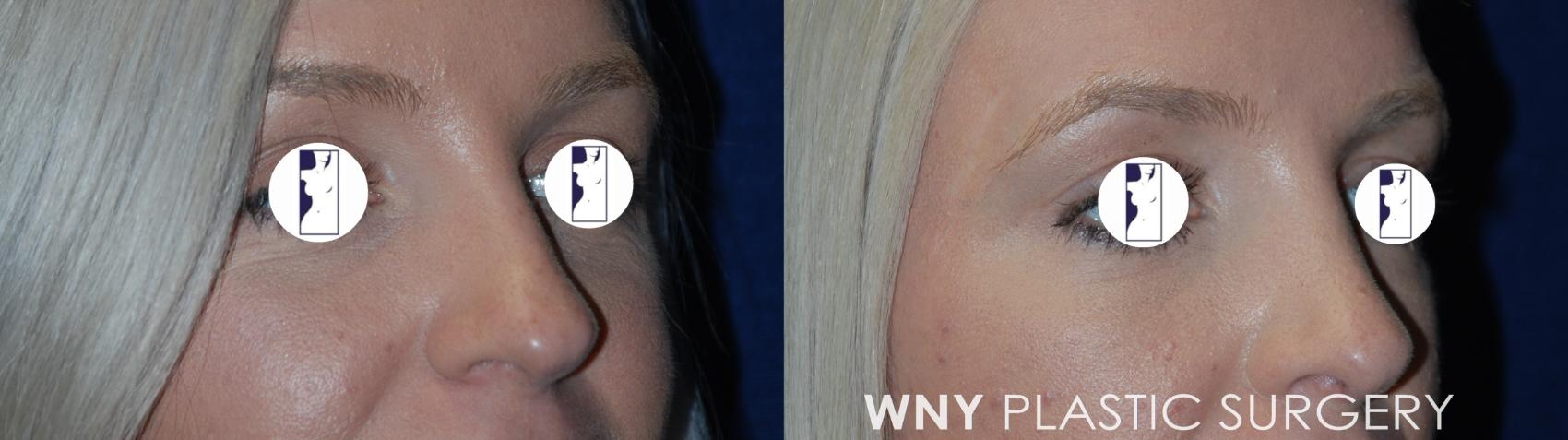 Before & After Rhinoplasty Case 67 Right Oblique View in Williamsville, NY