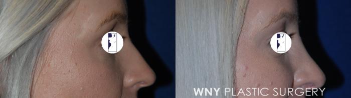 Before & After Rhinoplasty Case 67 Right Side View in Williamsville, NY