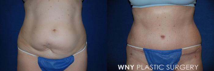 Before & After Tummy Tuck Case 14 View #1 View in Williamsville, NY