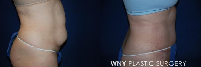 Before & After Tummy Tuck Case 14 View #2 View in Williamsville, NY
