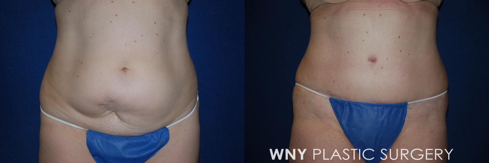 Before & After Tummy Tuck Case 14 View #3 View in Williamsville, NY