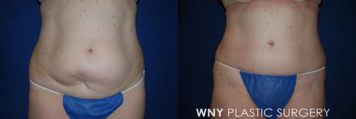 Before & After Tummy Tuck Case 14 View #3 View in Williamsville, NY