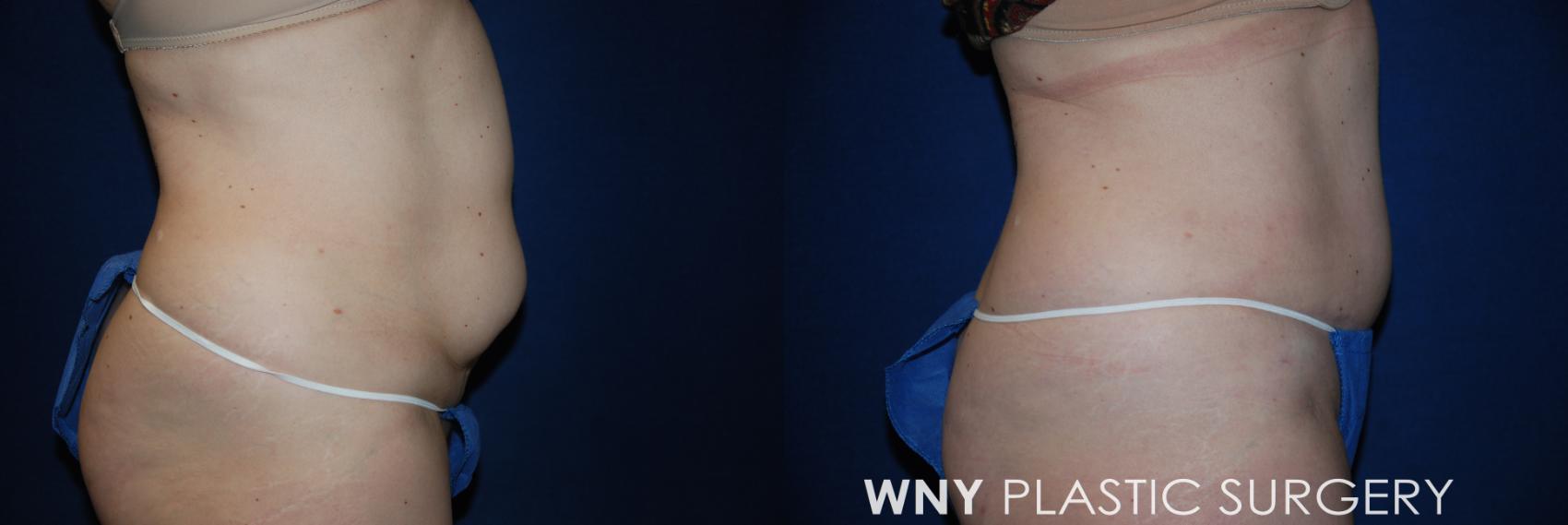 Before & After Tummy Tuck Case 14 View #4 View in Williamsville, NY