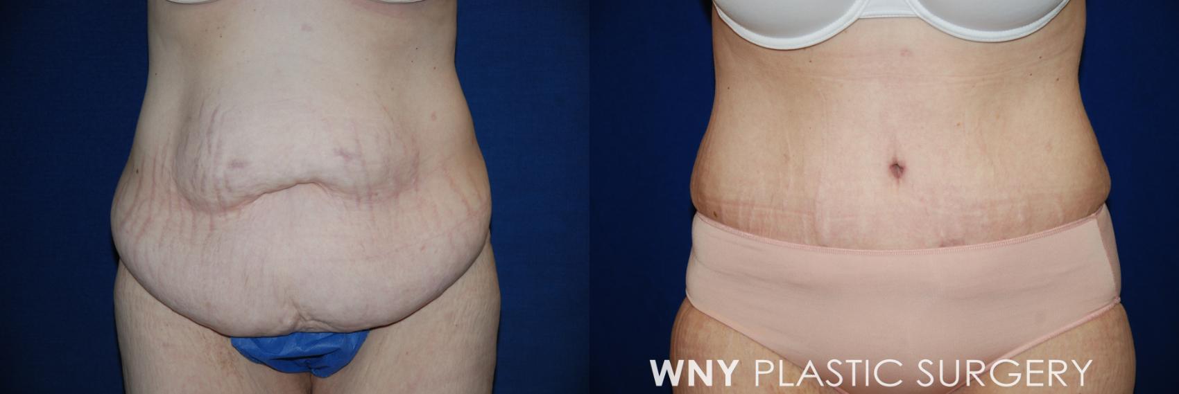 Before & After Tummy Tuck Case 15 View #1 View in Buffalo, NY