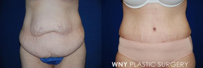 Before & After Tummy Tuck Case 15 View #1 View in Williamsville, NY