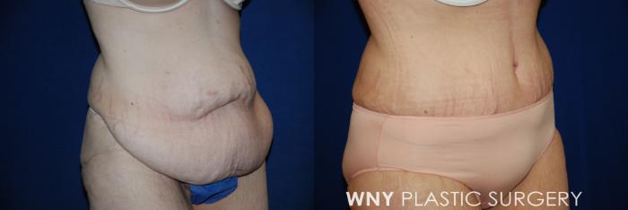 Before & After Tummy Tuck Case 15 View #2 View in Williamsville, NY