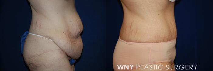 Before & After Tummy Tuck Case 15 View #3 View in Williamsville, NY