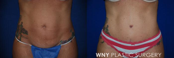 Before & After Tummy Tuck Case 16 Front View in Buffalo, NY