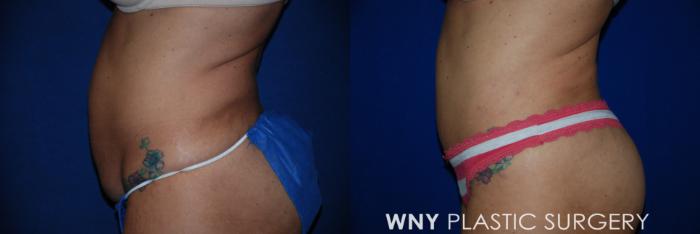 Before & After Tummy Tuck Case 16 Left Side View in Buffalo, NY