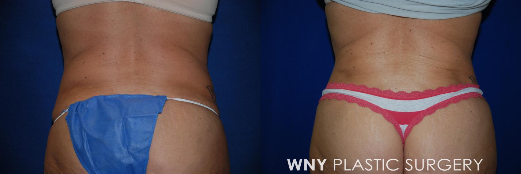 Before & After Tummy Tuck Case 16 View #3 View in Williamsville, NY