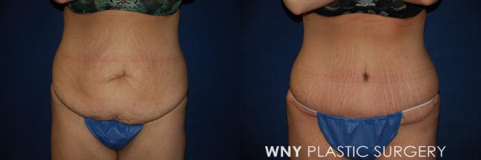 Before & After Tummy Tuck Case 166 View #1 View in Buffalo, NY