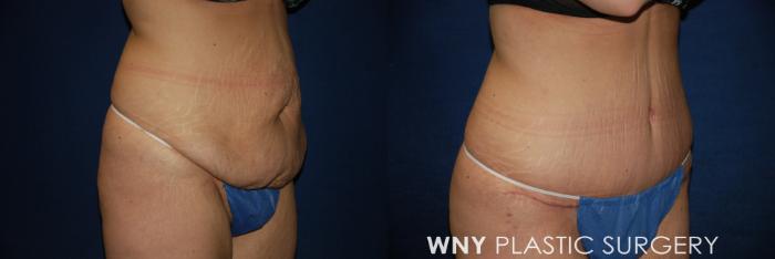 Before & After Tummy Tuck Case 166 View #2 View in Buffalo, NY