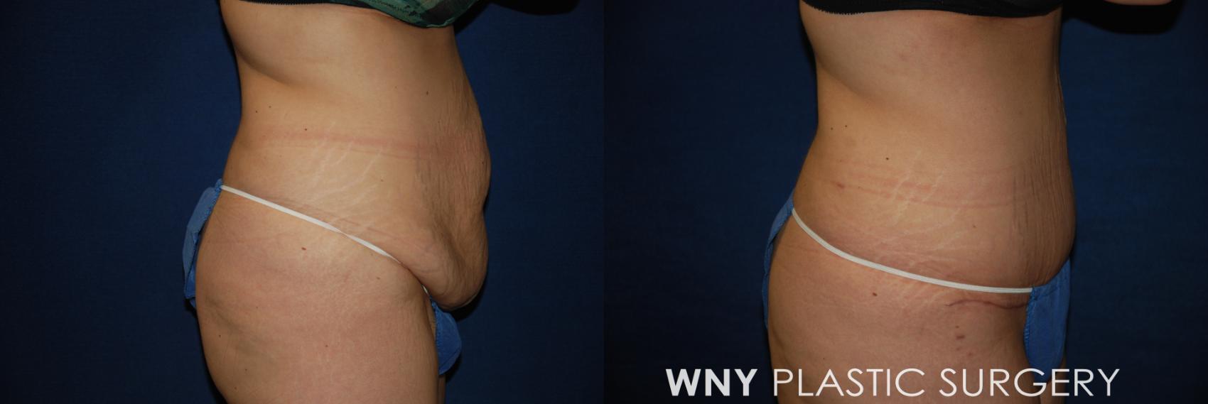 Before & After Tummy Tuck Case 166 View #3 View in Williamsville, NY