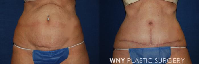 Before & After Tummy Tuck Case 187 Front View in Williamsville, NY