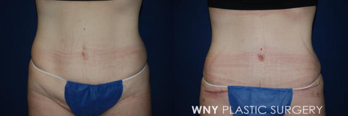 Before & After Tummy Tuck Case 188 Front View in Williamsville, NY